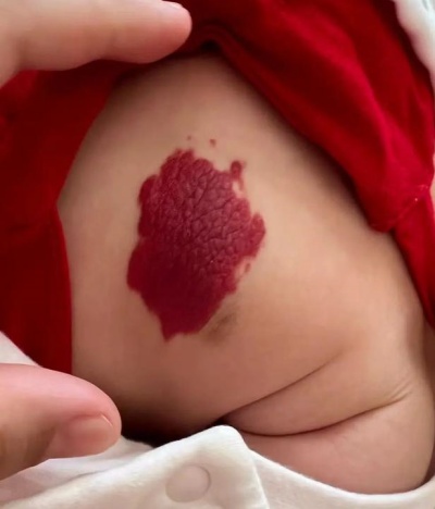 血管瘤出现哪些情况需要注意？