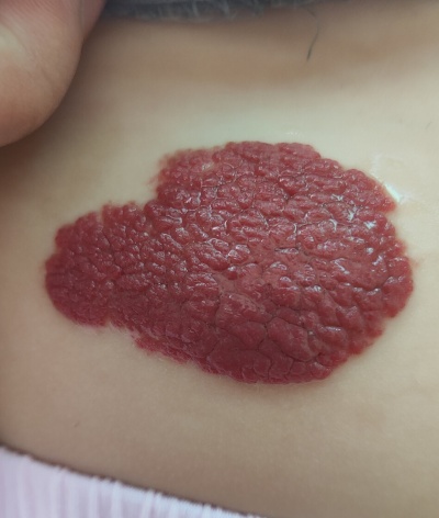 血管瘤出现哪些情况需要注意？